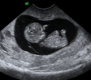 eightweeksafterconception1